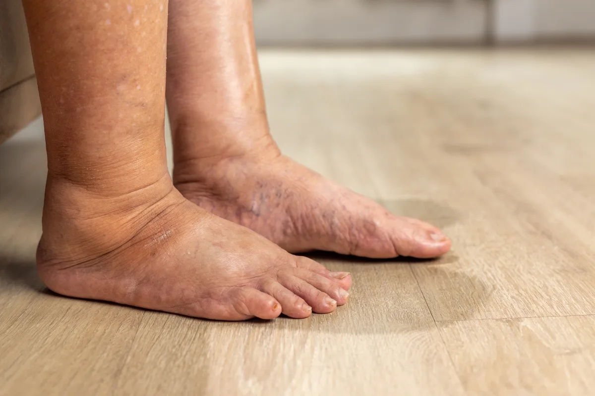 diabetická noha v dôsledku nadváhy