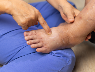 Diabetická noha patrí medzi najčastejšie a najzávažnejšie komplikácie cukrovky.