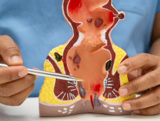 Hemoroidy sú častým problémom, ktorý prináša bolesť, opuch, zápal a krvácanie. Mnohí pacienti volia chirurgický zákrok ako riešenie, avšak ani operácia nie vždy zaručí trvalé odstránenie problému