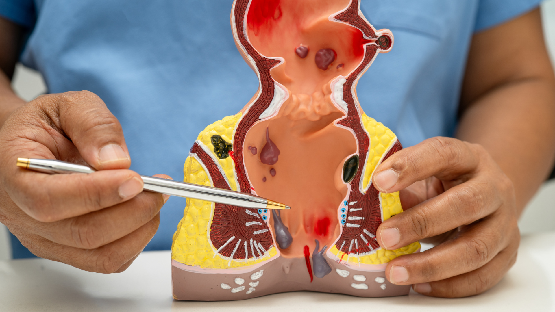 Hemoroidy sú častým problémom, ktorý prináša bolesť, opuch, zápal a krvácanie. Mnohí pacienti volia chirurgický zákrok ako riešenie, avšak ani operácia nie vždy zaručí trvalé odstránenie problému