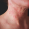 chronical_eczema
